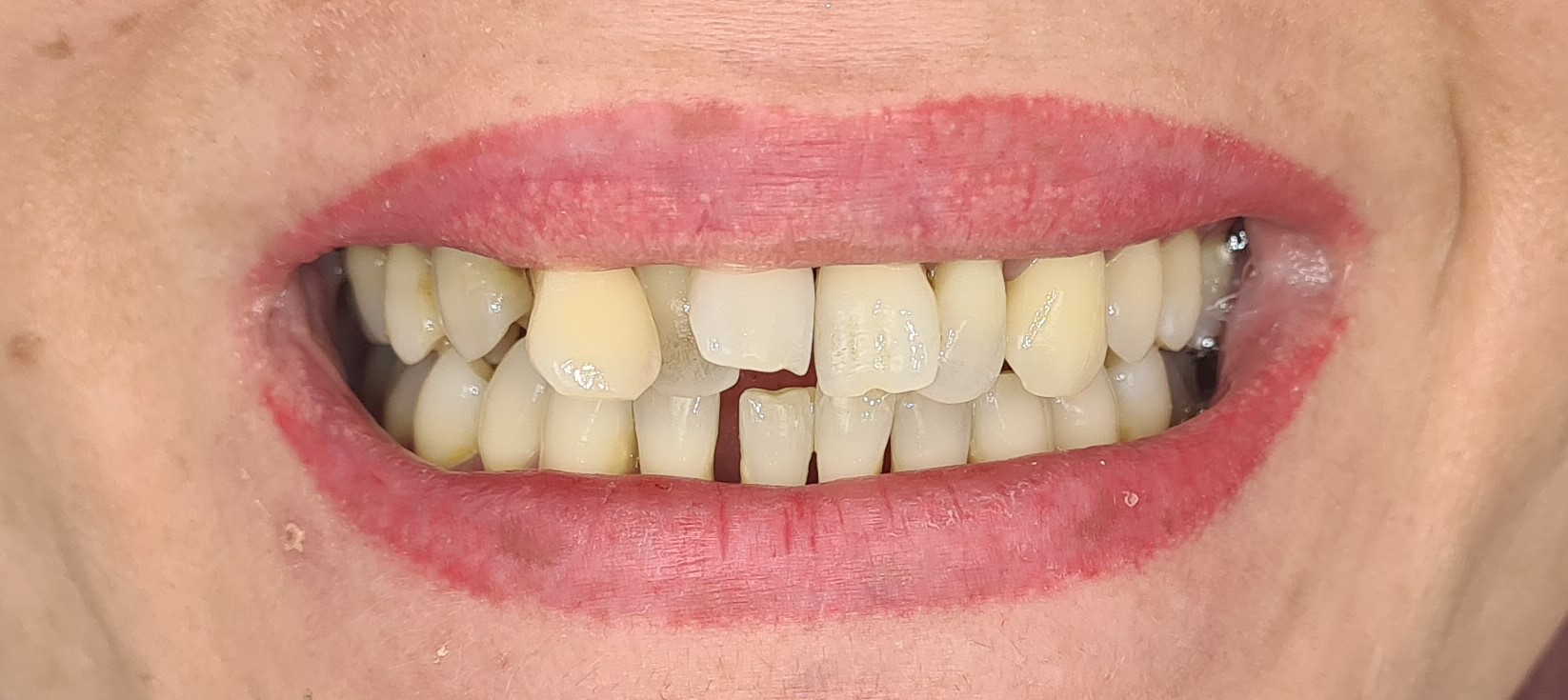 Extractie dentara inainte